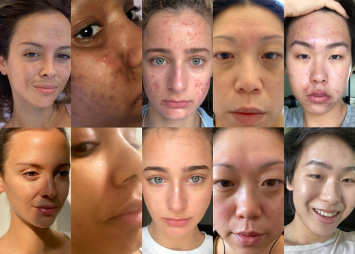 5 POWERFUL SKIN TRANSFORMATIONS