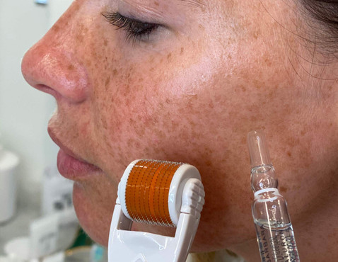 HOW DOES MICRONEEDLING  WORK?