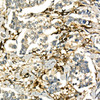 Immunohistochemistry of paraffin-embedded human breast cancer using LTA Rabbit pAb at dilution of 1:50 (40x lens). Perform high pressure antigen retrieval with 10 mM citrate buffer pH 6. 0 before commencing with IHC staining protocol.