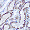 Immunohistochemistry of paraffin-embedded human esophageal cancer using PLK1 Rabbit mAb at dilution of 1:100 (40x lens). Perform high pressure antigen retrieval with 10 mM citrate buffer pH 6. 0 before commencing with IHC staining protocol.