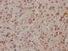 IHC image of PACO64893 diluted at 1:300 and staining in paraffin-embedded human glioma cancer performed on a Leica BondTM system. After dewaxing and hydration, antigen retrieval was mediated by high pressure in a citrate buffer (pH 6.0). Section was blocked with 10% normal goat serum 30min at RT. Then primary antibody (1% BSA) was incubated at 4&deg;C overnight. The primary is detected by a Goat anti-rabbit IgG labeled by HRP and visualized using 0.05% DAB.