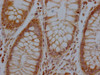 IHC image of PACO64914 diluted at 1:100 and staining in paraffin-embedded human colon cancer performed on a Leica BondTM system. After dewaxing and hydration, antigen retrieval was mediated by high pressure in a citrate buffer (pH 6.0). Section was blocked with 10% normal goat serum 30min at RT. Then primary antibody (1% BSA) was incubated at 4&deg;C overnight. The primary is detected by a Goat anti-rabbit polymer IgG labeled by HRP and visualized using 0.05% DAB.