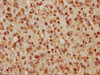 IHC image of PACO65048 diluted at 1:5 and staining in paraffin-embedded human glioma cancer performed on a Leica BondTM system. After dewaxing and hydration, antigen retrieval was mediated by high pressure in a citrate buffer (pH 6.0). Section was blocked with 10% normal goat serum 30min at RT. Then primary antibody (1% BSA) was incubated at 4&deg;C overnight. The primary is detected by a biotinylated secondary antibody and visualized using an HRP conjugated SP system.