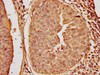 IHC image of PACO65054 diluted at 1:20 and staining in paraffin-embedded human cervical cancer performed on a Leica BondTM system. After dewaxing and hydration, antigen retrieval was mediated by high pressure in a citrate buffer (pH 6.0). Section was blocked with 10% normal goat serum 30min at RT. Then primary antibody (1% BSA) was incubated at 4&deg;C overnight. The primary is detected by a biotinylated secondary antibody and visualized using an HRP conjugated SP system.