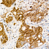 Immunohistochemistry analysis of paraffin-embedded human colon carcinoma using SOD1 Rabbit mAb (CAB21211) at dilution of 1:1000(40x lens). Perform high pressure antigen retrieval with 10 mM citrate buffer pH 6. 0 before commencing with IHC staining protocol.