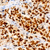 Immunohistochemistry analysis of paraffin-embedded Human lung adenocarcinoma using NKX2-1 Rabbit mAb (CAB22248) at dilution of 1:100 (40x lens). Perform high pressure antigen retrieval with 10 mM citrate buffer pH 6. 0 before commencing with IHC staining protocol.