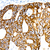 Immunohistochemistry analysis of paraffin-embedded human colon carcinoma using Cytokeratin 19 (KRT19) Rabbit mAb (CAB22427) at dilution of 1:100 (40x lens). Perform microwave antigen retrieval with 10 mM PBS buffer pH 7. 2 before commencing with IHC staining protocol.