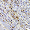 Immunohistochemistry analysis of paraffin-embedded human colon carcinoma using Ferritin Heavy Chain Rabbit mAb (CAB22439) at dilution of 1:100 (40x lens). Perform high pressure antigen retrieval with 10 mM citrate buffer pH 6. 0 before commencing with IHC staining protocol.