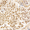 Immunohistochemistry analysis of paraffin-embedded human lung squamous carcinoma tissue using MDM2 Rabbit mAb (CAB23387) at dilution of 1:100 (40x lens). Perform high pressure antigen retrieval with 10 mM citrate buffer pH 6. 0 before commencing with IHC staining protocol.