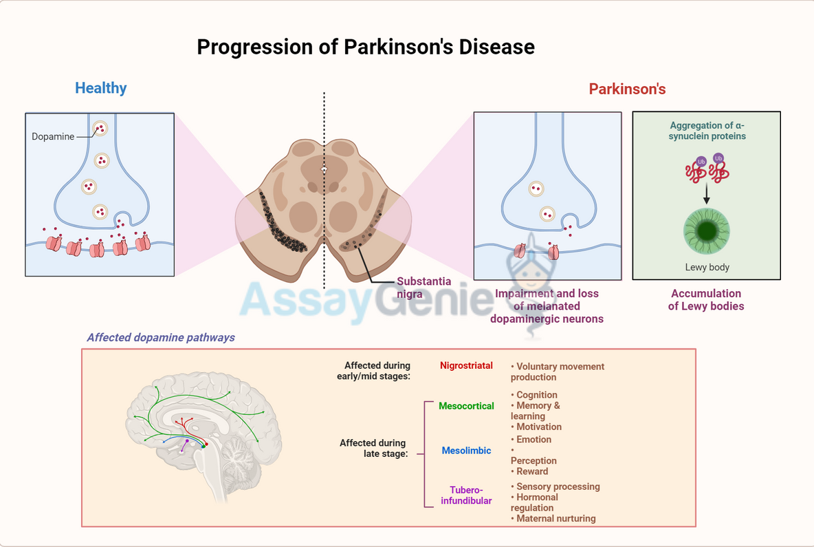 Understanding Parkinson's Disease: Insights and Innovations