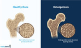 Understanding Bone Resorption: Key Definitions and Processes