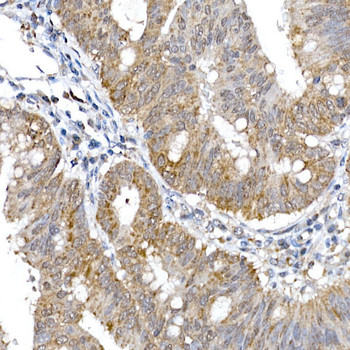 Immunohistochemistry of paraffin-embedded human colon carcinoma using SRP72 Rabbit pAb at dilution of 1:100 (40x lens). Perform high pressure antigen retrieval with 10 mM citrate buffer pH 6. 0 before commencing with IHC staining protocol.