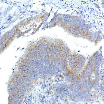Immunohistochemistry of paraffin-embedded human colon carcinoma using Syntaxin 16 Rabbit mAb at dilution of 1:50 (40x lens). Perform high pressure antigen retrieval with 10 mM citrate buffer pH 6. 0 before commencing with IHC staining protocol.