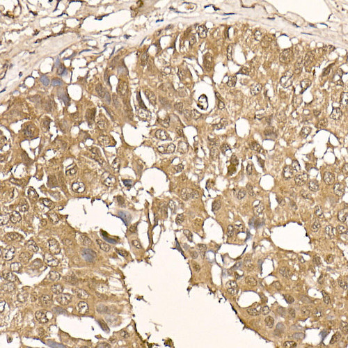 Immunohistochemistry of paraffin-embedded human breast cancer using [KO Validated] AKT1 Rabbit mAb at dilution of 1:100 (40x lens). Perform high pressure antigen retrieval with 10 mM citrate buffer pH 6. 0 before commencing with IHC staining protocol.