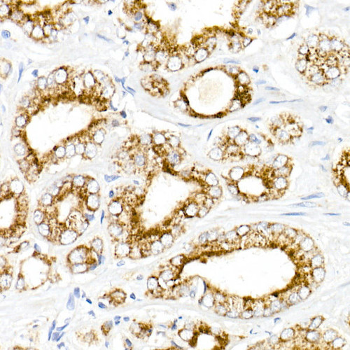 Immunohistochemistry of paraffin-embedded human prostate cancer using AMACR Rabbit mAb at dilution of 1:50 (40x lens). Perform high pressure antigen retrieval with 10 mM citrate buffer pH 6. 0 before commencing with IHC staining protocol.