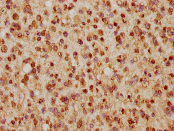 IHC image of PACO65048 diluted at 1:5 and staining in paraffin-embedded human glioma cancer performed on a Leica BondTM system. After dewaxing and hydration, antigen retrieval was mediated by high pressure in a citrate buffer (pH 6.0). Section was blocked with 10% normal goat serum 30min at RT. Then primary antibody (1% BSA) was incubated at 4&deg;C overnight. The primary is detected by a biotinylated secondary antibody and visualized using an HRP conjugated SP system.