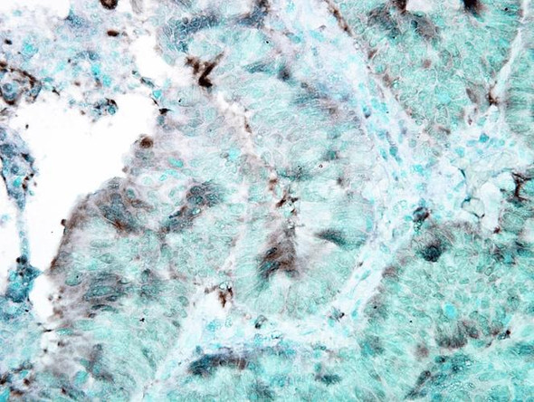 Immunohistochemistry analysis using Mouse Anti-Hsp90 Monoclonal Antibody, Clone 4F3.E8 (STMA00028). Tissue: colon carcinoma. Species: Human. Fixation: Formalin. Primary Antibody: Mouse Anti-Hsp90 Monoclonal Antibody (STMA00028) at 1:100000 for 12 hours at 4°C. Secondary Antibody: Biotin Goat Anti-Mouse at 1:2000 for 1 hour at RT. Counterstain: Mayer Hematoxylin (purple/blue) nuclear stain at 200 µl for 2 minutes at RT.