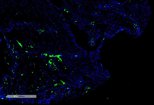 Immunohistochemistry analysis using Mouse Anti-Citrulline Monoclonal Antibody, Clone 2D3.1 (STMA00173). Tissue: Thyroid Cancer. Species: Human. Primary Antibody: Mouse Anti-Citrulline Monoclonal Antibody (STMA00173) at 1:100 for Overnight at 4C, then 30 min at 37C. Secondary Antibody: Goat Anti-Mouse IgG (H+L): FITC for 45 min at 37C. Counterstain: DAPI for 3 min at RT. Magnification: 5X.