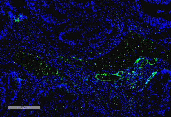 Immunohistochemistry analysis using Mouse Anti-VPS35 Monoclonal Antibody, Clone 10A8 (STMA00211). Tissue: Thyroid Cancer. Species: Human. Primary Antibody: Mouse Anti-VPS35 Monoclonal Antibody (STMA00211) at 1:100 for Overnight at 4C, then 30 min at 37C. Secondary Antibody: Goat Anti-Mouse IgG (H+L): FITC for 45 min at 37C. Counterstain: DAPI for 3 min at RT. Magnification: 10X.