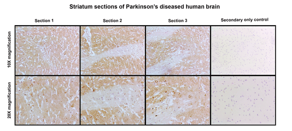 Immunohistochemistry analysis with Mouse Anti-Human Alpha Synuclein N-Terminal Monoclonal Antibody, Clone 11D4 (STMA00225). Tissue: Striatum sections of Parkinson’s Diseased Brain. Species: Human. Fixation: Paraffin embedded, 5um thin. Blocking: 3% milk for 1 hour at RT. Antigen Retrieval: Citrate buffer, pH 6.0, boiled for 20 min. Primary Antibody: Mouse Anti-Human Alpha Synuclein N-Terminal Monoclonal Antibody, Clone 11D4 (STMA00225).