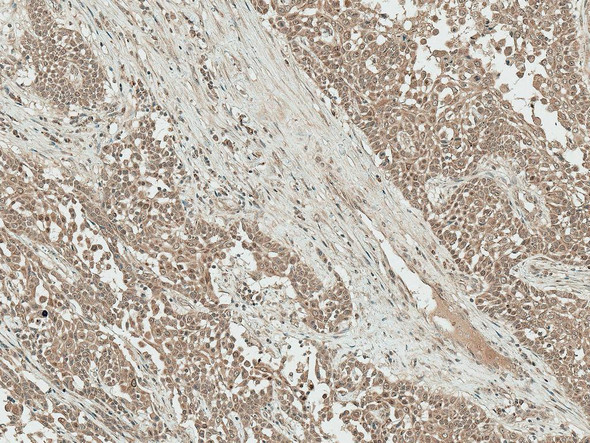 Immunohistochemistry analysis using Rabbit Anti-IGF-1 Polyclonal Antibody (STPA00070). Tissue: Liver. Species: Human. Fixation: Formalin Fixed Paraffin-Embedded. Primary Antibody: Rabbit Anti-IGF-1 Polyclonal Antibody (STPA00070) at 1:50 for 30 min at RT. Counterstain: Hematoxylin. Magnification: 10X. HRP-DAB Detection.