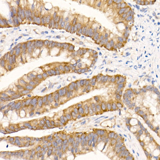 Immunohistochemistry of paraffin-embedded human colon carcinoma using eIF1A Rabbit mAb at dilution of 1:50 (40x lens). Perform high pressure antigen retrieval with 10 mM citrate buffer pH 6. 0 before commencing with IHC staining protocol.