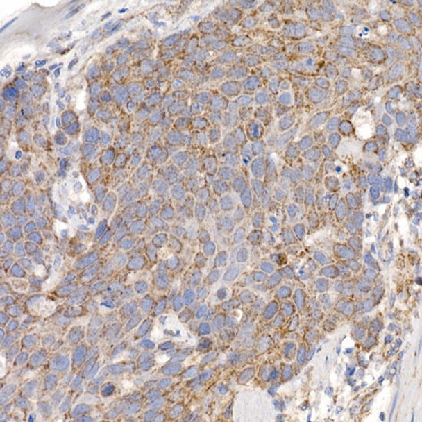 Immunohistochemistry of paraffin-embedded human esophageal cancer using MMUT Rabbit mAb at dilution of 1:25 (40x lens). Perform high pressure antigen retrieval with 10 mM citrate buffer pH 6. 0 before commencing with IHC staining protocol.