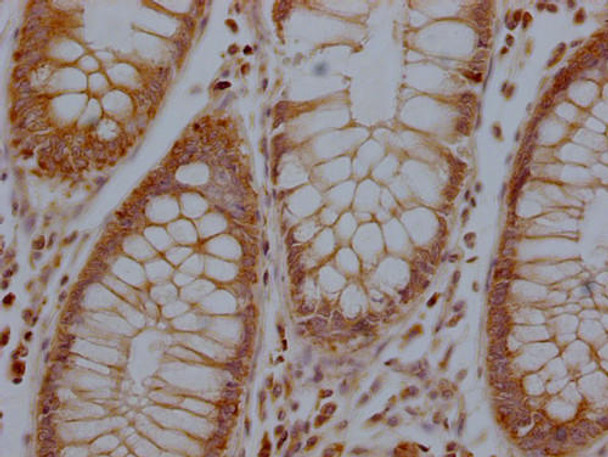 IHC image of PACO64914 diluted at 1:100 and staining in paraffin-embedded human colon cancer performed on a Leica BondTM system. After dewaxing and hydration, antigen retrieval was mediated by high pressure in a citrate buffer (pH 6.0). Section was blocked with 10% normal goat serum 30min at RT. Then primary antibody (1% BSA) was incubated at 4&deg;C overnight. The primary is detected by a Goat anti-rabbit polymer IgG labeled by HRP and visualized using 0.05% DAB.