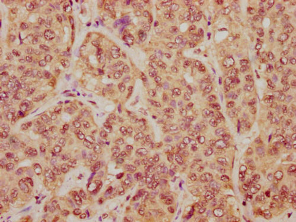 IHC image of PACO65047 diluted at 1:20 and staining in paraffin-embedded human liver cancer performed on a Leica BondTM system. After dewaxing and hydration, antigen retrieval was mediated by high pressure in a citrate buffer (pH 6.0). Section was blocked with 10% normal goat serum 30min at RT. Then primary antibody (1% BSA) was incubated at 4&deg;C overnight. The primary is detected by a biotinylated secondary antibody and visualized using an HRP conjugated SP system.