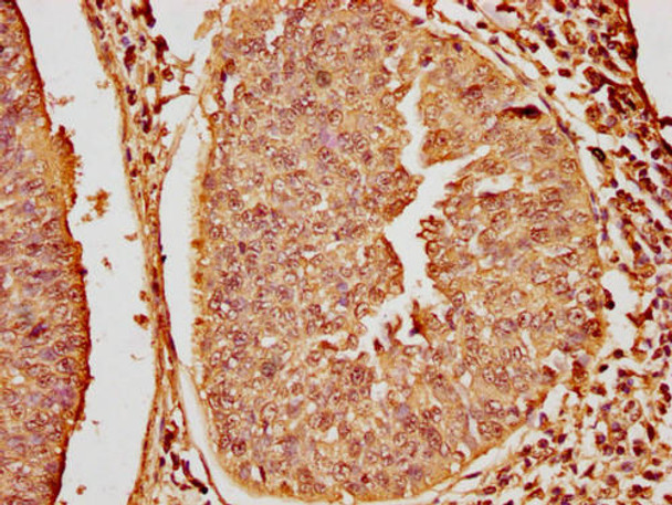 IHC image of PACO65054 diluted at 1:20 and staining in paraffin-embedded human cervical cancer performed on a Leica BondTM system. After dewaxing and hydration, antigen retrieval was mediated by high pressure in a citrate buffer (pH 6.0). Section was blocked with 10% normal goat serum 30min at RT. Then primary antibody (1% BSA) was incubated at 4&deg;C overnight. The primary is detected by a biotinylated secondary antibody and visualized using an HRP conjugated SP system.