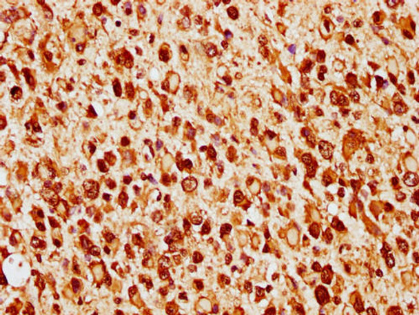 IHC image of PACO65097 diluted at 1:14 and staining in paraffin-embedded human glioma cancer performed on a Leica BondTM system. After dewaxing and hydration, antigen retrieval was mediated by high pressure in a citrate buffer (pH 6.0). Section was blocked with 10% normal goat serum 30min at RT. Then primary antibody (1% BSA) was incubated at 4&deg;C overnight. The primary is detected by a biotinylated secondary antibody and visualized using an HRP conjugated SP system.