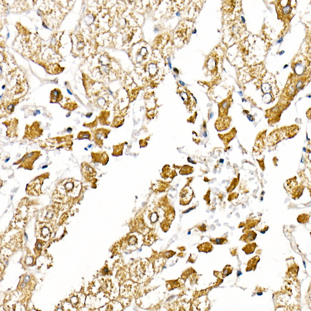 Immunohistochemistry analysis of paraffin-embedded human liver cancer using Caspase-1 Rabbit pAb (CAB21296) at dilution of 1:20 (40x lens). Perform high pressure antigen retrieval with 10 mM citrate buffer pH 6. 0 before commencing with IHC staining protocol.