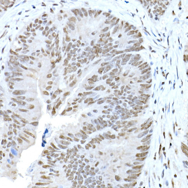 Immunohistochemistry analysis of paraffin-embedded human colon carcinoma using CREB1 Rabbit pAb (CAB21362) at dilution of 1:100 (40x lens). Perform high pressure antigen retrieval with 10 mM citrate buffer pH 6. 0 before commencing with IHC staining protocol.