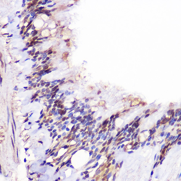 Immunohistochemistry analysis of paraffin-embedded human lung using JMJD6 Rabbit pAb (CAB21829) at dilution of 1:100 (40x lens). Perform high pressure antigen retrieval with 10 mM citrate buffer pH 6. 0 before commencing with IHC staining protocol.