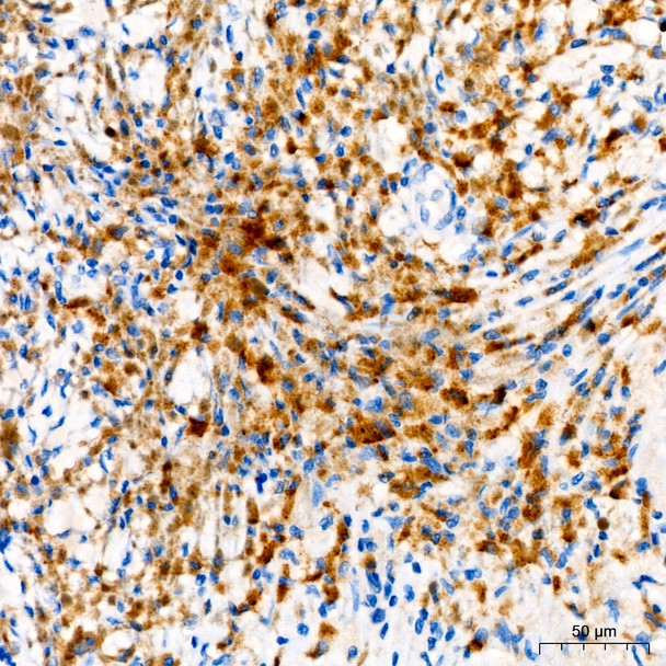 Immunohistochemistry analysis of paraffin-embedded Human malignant melanoma using Tyrosinase Rabbit mAb (CAB23209) at dilution of 1:100 (40x lens). Perform high pressure antigen retrieval with 10 mM Tris/EDTA buffer pH 9. 0 before commencing with IHC staining protocol.