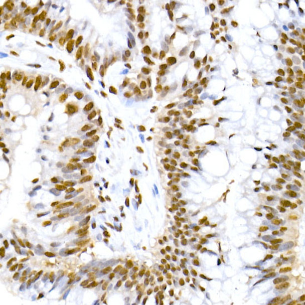 Immunohistochemistry analysis of paraffin-embedded human colon carcinoma using Phospho-MDM2-S166 Rabbit mAb (CABP1308) at dilution of 1:20 (40x lens). Perform high pressure antigen retrieval with 10 mM citrate buffer pH 6. 0 before commencing with IHC staining protocol.