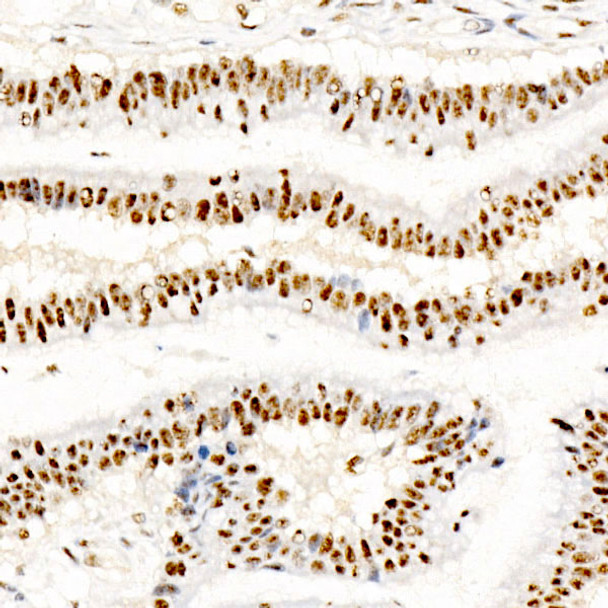 Immunohistochemistry analysis of paraffin-embedded human colon carcinoma using Phospho-CREB1-S133 Rabbit mAb (CABP1421) at dilution of 1:100 (40x lens). Perform high pressure antigen retrieval with 10 mM citrate buffer pH 6. 0 before commencing with IHC staining protocol.