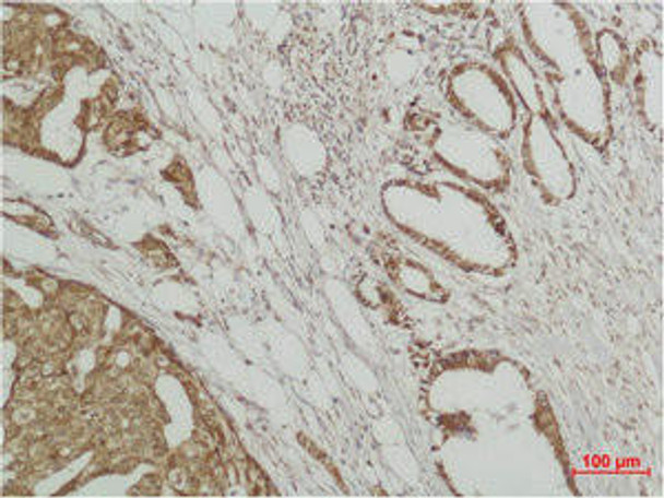 Immunohistochemical analysis of paraffin-embedded human Breast caricnoma using ERK 3 Polyclonal Antibody. MAPK6 Antibody (PACO07004)