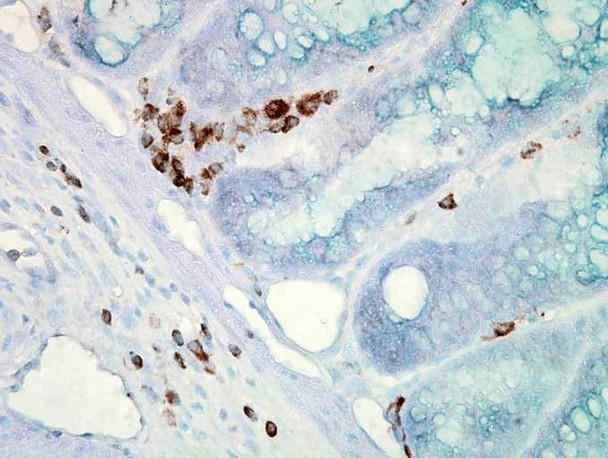 Immunohistochemistry analysis using Mouse Anti-Hsp70 Monoclonal Antibody, Clone C92F3A-5 (STMA00001). Tissue: colon carcinoma. Species: Mouse. Fixation: Formalin. Primary Antibody: Mouse Anti-Hsp70 Monoclonal Antibody (STMA00001) at 1:10000 for 12 hours at 4°C. Secondary Antibody: Biotin Goat Anti-Mouse at 1:2000 for 1 hour at RT. Counterstain: Mayer Hematoxylin (purple/blue) nuclear stain at 200 µl for 2 minutes at RT.