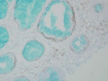 Immunohistochemistry analysis using Mouse Anti-DNMT1 Monoclonal Antibody, Clone 60B1220.1 (STMA00056). Tissue: colon carcinoma. Species: Human. Fixation: Formalin. Primary Antibody: Mouse Anti-DNMT1 Monoclonal Antibody (STMA00056) at 1:10000 for 12 hours at 4°C. Secondary Antibody: Biotin Goat Anti-Mouse at 1:2000 for 1 hour at RT. Counterstain: Mayer Hematoxylin (purple/blue) nuclear stain at 200 µl for 2 minutes at RT. Magnification: 40x.