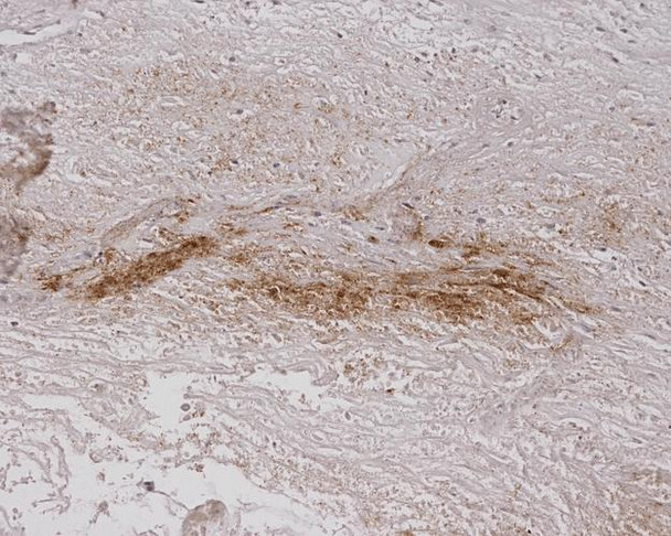 Immunohistochemistry analysis using Mouse Anti-Alginate Monoclonal Antibody, Clone 4B10-1C5 (STMA00060). Tissue: Burned Skin. Species: Human. Primary Antibody: Mouse Anti-Alginate Monoclonal Antibody (STMA00060) at 1:200.