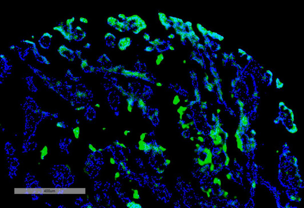 Immunohistochemistry analysis using Rabbit Anti-Thymidine Glycol Monoclonal Antibody, Clone B29 (STMA00217). Tissue: renal cancer. Species: Human. Primary Antibody: Rabbit Anti-Thymidine Glycol Monoclonal Antibody (STMA00217) at 1:100 for Overnight at 4C, then 30 min at 37C. Secondary Antibody: Goat Anti-Mouse IgG (H+L): FITC for 45 min at 37C. Counterstain: DAPI for 3 min at RT.