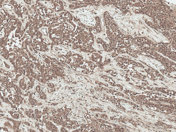 Immunohistochemistry analysis using Rabbit Anti-SFRP2 Polyclonal Antibody (STPA00085). Tissue: Liver. Species: Human. Fixation: Formalin Fixed Paraffin-Embedded. Primary Antibody: Rabbit Anti-SFRP2 Polyclonal Antibody (STPA00085) at 1:50 for 30 min at RT. Counterstain: Hematoxylin. Magnification: 20X. HRP-DAB Detection.