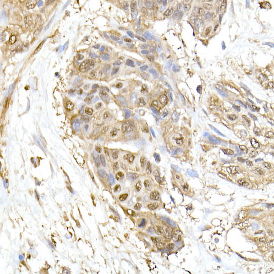 Immunohistochemistry of paraffin-embedded human esophageal cancer using HSP70 Rabbit pAb at dilution of 1:150 (40x lens). Perform high pressure antigen retrieval with 10 mM citrate buffer pH 6. 0 before commencing with IHC staining protocol.