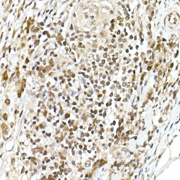 Immunohistochemistry of paraffin-embedded human colon carcinoma using TCF1/TCF7 Rabbit mAb at dilution of 1:100 (40x lens). Perform high pressure antigen retrieval with 10 mM citrate buffer pH 6. 0 before commencing with IHC staining protocol.