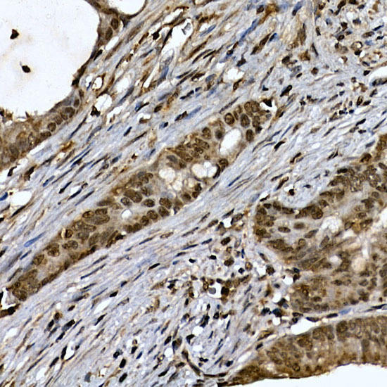 Immunohistochemistry of paraffin-embedded human colon carcinoma using ZNF213 Rabbit pAb at dilution of 1:150 (40x lens). Perform high pressure antigen retrieval with 10 mM citrate buffer pH 6. 0 before commencing with IHC staining protocol.