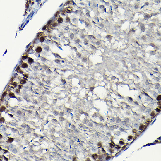 Immunohistochemistry of paraffin-embedded human colon carcinoma using PLK1 Rabbit mAb at dilution of 1:100 (40x lens). Perform high pressure antigen retrieval with 10 mM citrate buffer pH 6. 0 before commencing with IHC staining protocol.