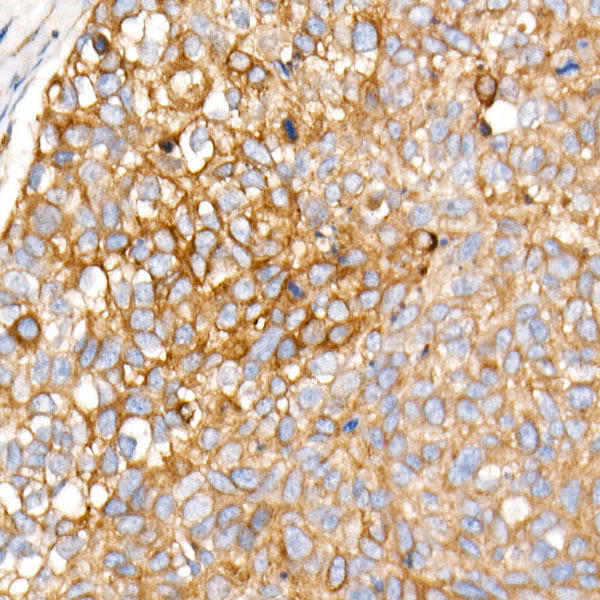 Immunohistochemistry of paraffin-embedded human esophageal cancer using PLOD3 Rabbit mAb at dilution of 1:1600 (40x lens). Perform high pressure antigen retrieval with 10 mM citrate buffer pH 6. 0 before commencing with IHC staining protocol.