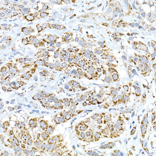 Immunohistochemistry of paraffin-embedded human esophageal cancer using FAM3A Rabbit pAb at dilution of 1:50 (40x lens). Perform high pressure antigen retrieval with 10 mM citrate buffer pH 6. 0 before commencing with IHC staining protocol.