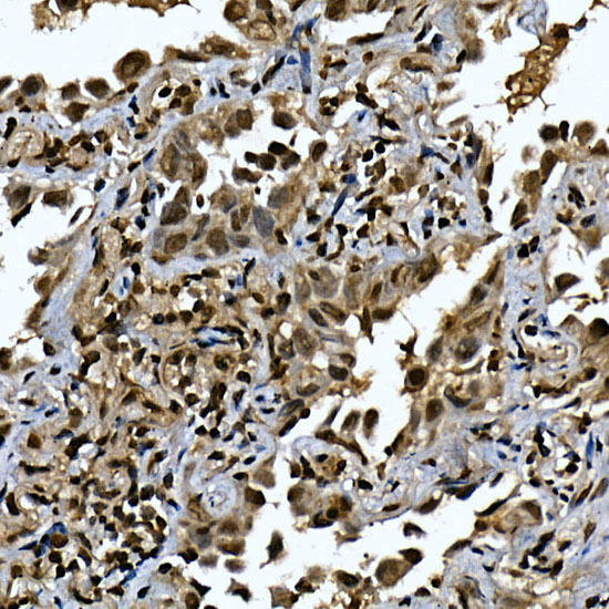 Immunohistochemistry of paraffin-embedded human lung cancer using ZNF213 Rabbit pAb at dilution of 1:150 (40x lens). Perform high pressure antigen retrieval with 10 mM citrate buffer pH 6. 0 before commencing with IHC staining protocol.